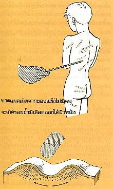 ลักษณะบาดแผลที่เกิดจากอาวุธชนิดต่างๆ